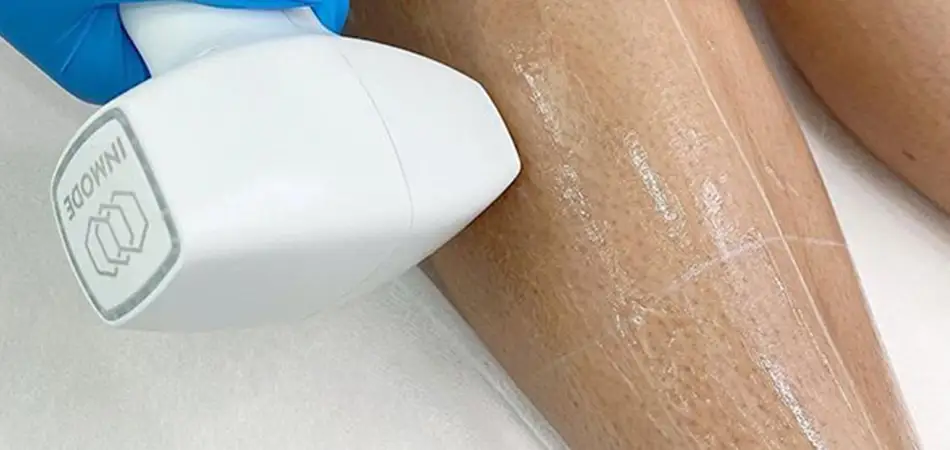 Laser Hair Removal
